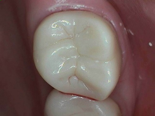 Crown placed to restore broken tooth