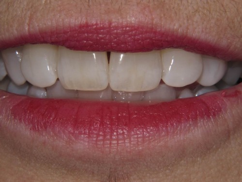 After teeth whitening