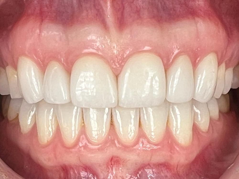 Upper crown placement, lower veneer placement