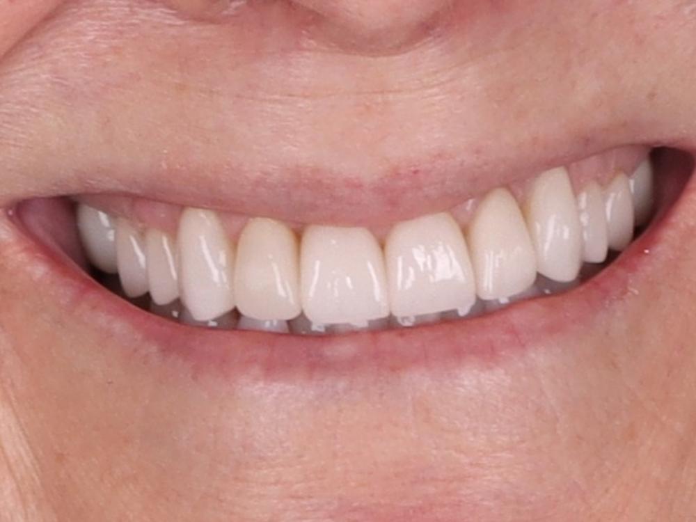 After Veneers